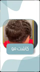 کلینیک زیبایی کاشت مو وابرو ایران مهر