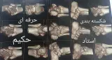 شکسته بندی، طب سنتی استادحکیم