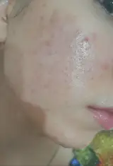 فیشال درمانی و پاکسازی پوست ندا میرجلیلی