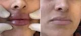هایفو، فشیال، اسکالپ دکتر علی اکبری