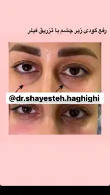مطب پوست و لیزر
