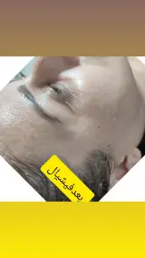 پاکسازی وجوانسازی پوست مهدیه