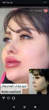 بوتاکس و فیلر پریسا مقنی