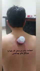 حجامت، زالو درمانی، فصدخون.برداشتن خال امجدیان