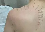 کلینیک فیزیوتراپی و طب سوزنی موحدی