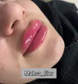 تزریق ژل و بوتاکس مهسا