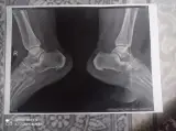 شکسته بندی استاد شهرزاد حکیم
