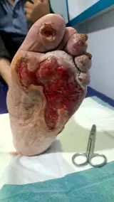 کارشناس تخصصی زخم در منزل