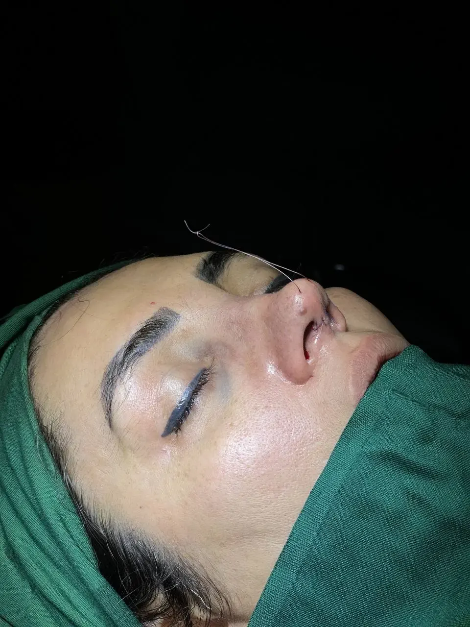 جراحی زیبایی بینی (دکتر مهدی محمدی)