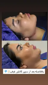 کلینیک زیبایی بوکال فت و سوپرکانتورغبغب