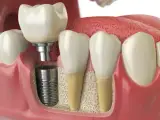 مرکزتخصصی ایمپلنت دکتر مومنی