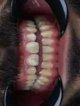 خدمات تخصصی ایمپلنت و لمینت دن