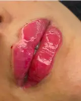 کلینیک تخصصی ژل و بوتاکس لب روسی در اسلامشهر
