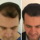 کلینیک کاشت مو پاسارگاد