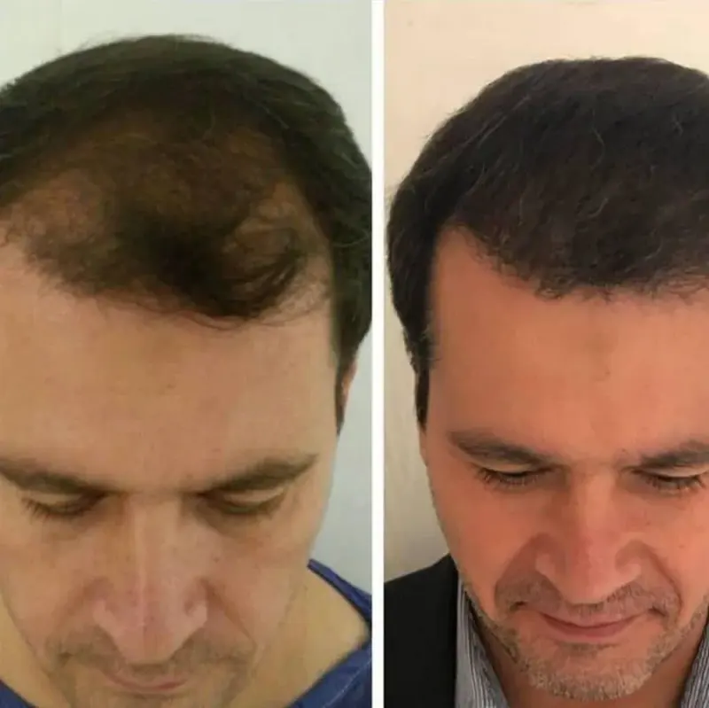 کلینیک کاشت مو پاسارگاد