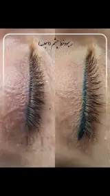 مرکز میکروبلیدینگ، شیدینگ، اسکالپ، ریموو