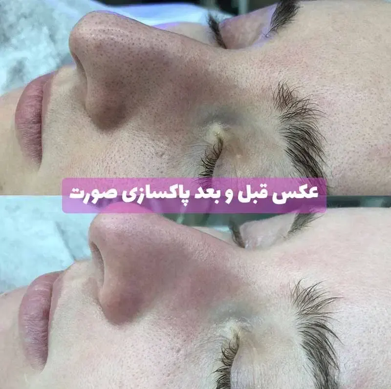 پاکسازی تخصصی پوست صورت کاشان