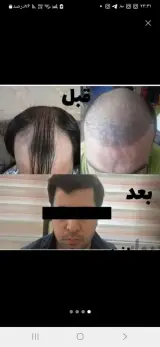 کلینیک کاشت مو و ابرو دنا