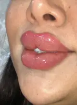 تزریقات ژل لب و کل نواحی صورت فاطیما