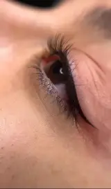 میکروبلیدینگ و میکروپیگمنتیشن سمیرا