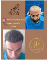 کاشت موی آلن