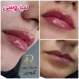 بوتاکس و فیلر(ژل لب) کرمان دکتر رضا سعیدی