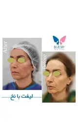 کلینیک آسمان آبى (مرکز کاشت ابرو کرج)