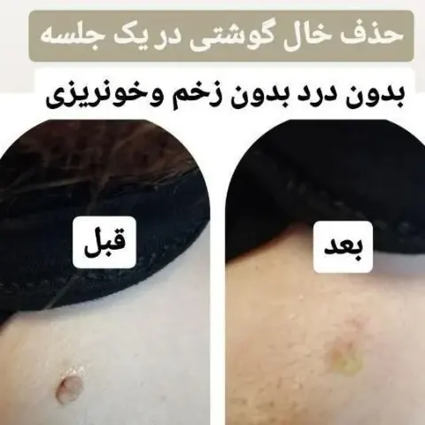 مرکز لیزر الماس
