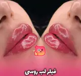 تزریق ژل لب وصورت حرفه ای