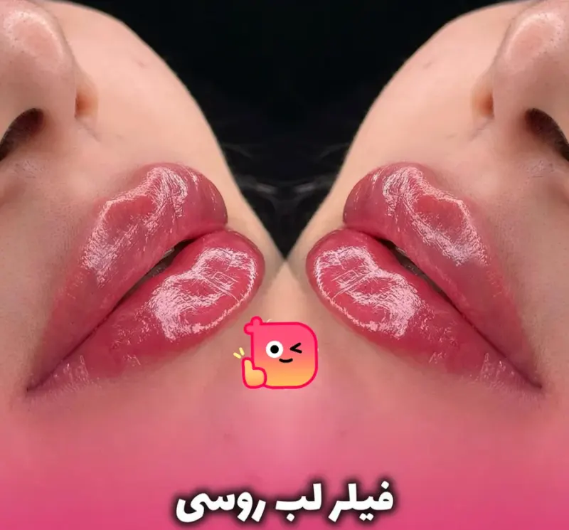 تزریق ژل لب وصورت حرفه ای