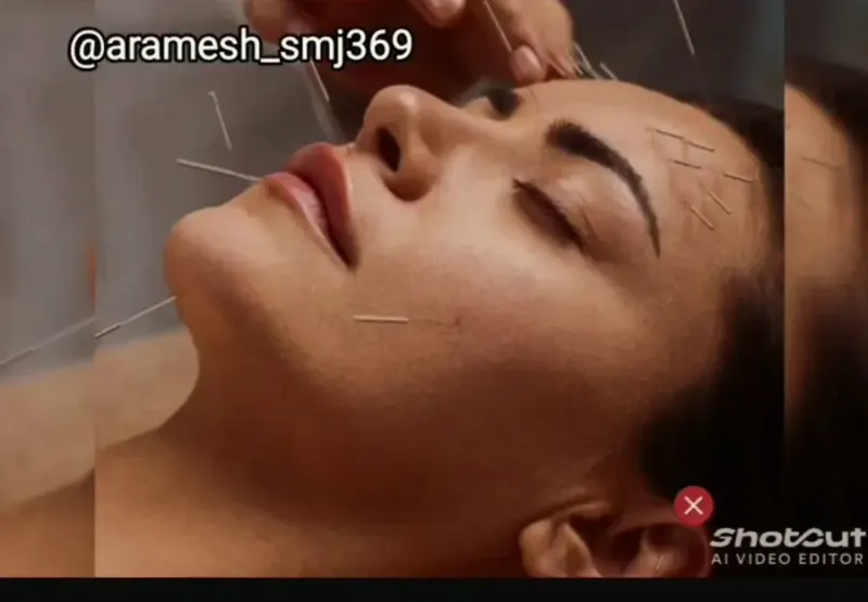 طب سوزنی زیبایی