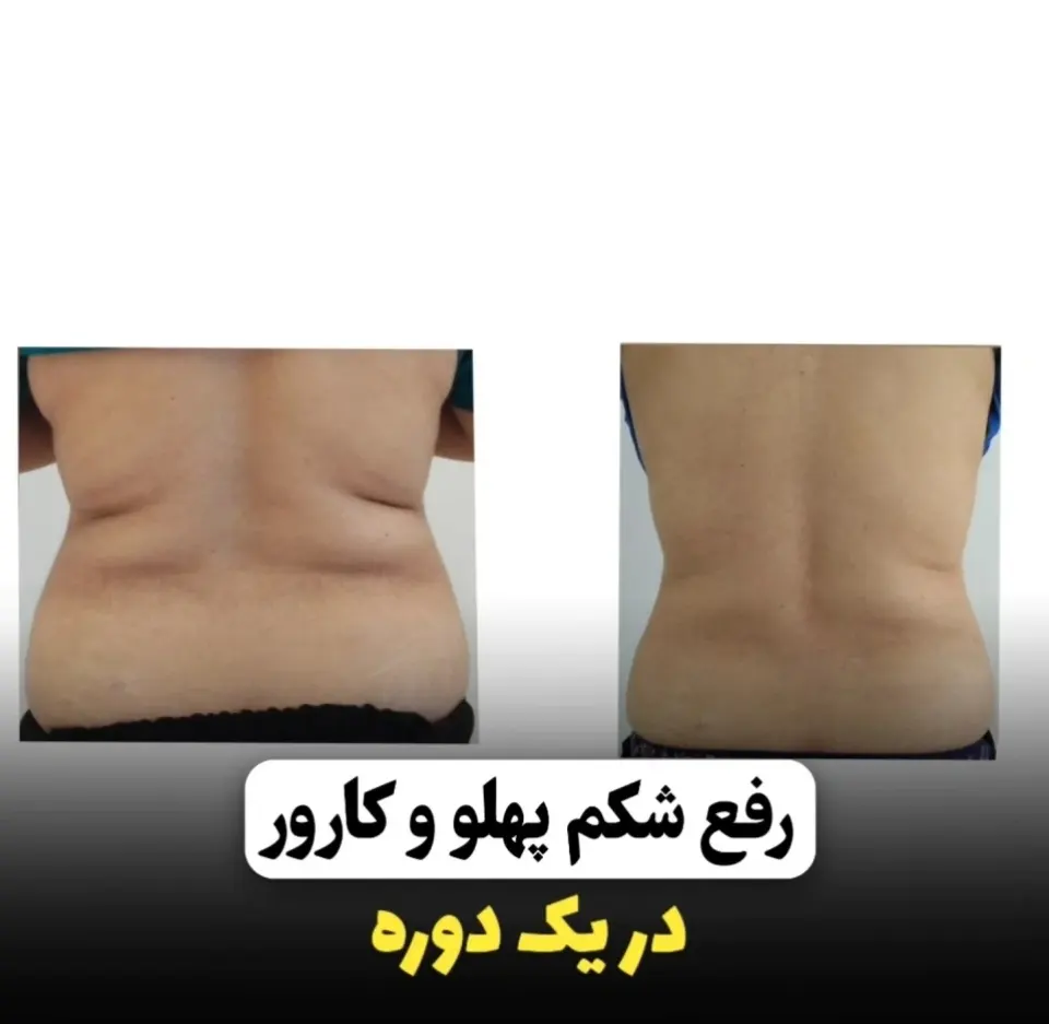 مرکز لاغری رادیکال