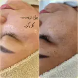 پاکسازی پوست اراک