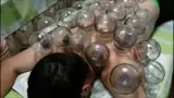 حجامت وزالو طب سنتی نیسی