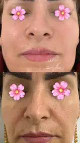 فیشال پوست آرا محمدی (کلینیک زرین)