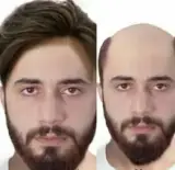 ترمیم پروتز مو احمدی در تهران