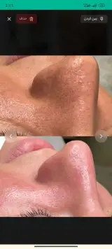 فیشال و پاکسازی پوست لونا در همدان