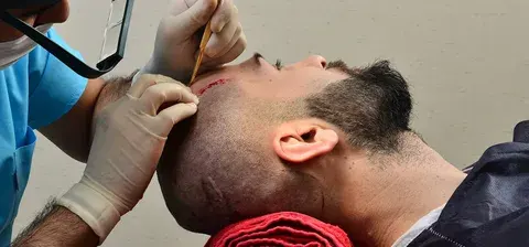 کلینیک تخصصی کاشت ابرو و مو صدف