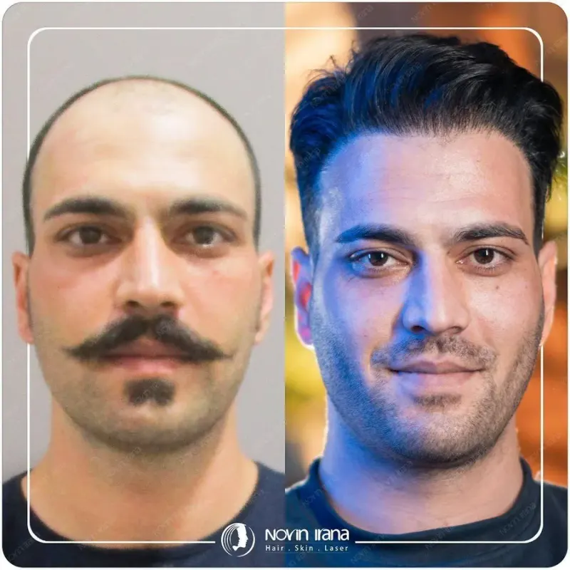 کلینیک کاشت مو نوین ایرانا