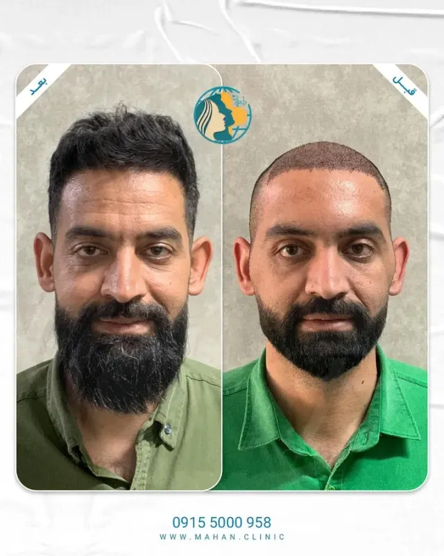کلینیک کاشت مو ماهان
