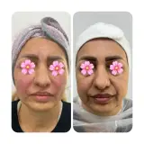 کلینیک زیبایی هانا(مرکز تخصصی فیلر بادی)