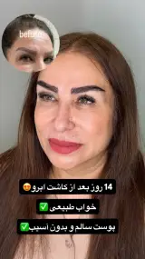 کاشت ابرو سلطانی متد پنج زاویه