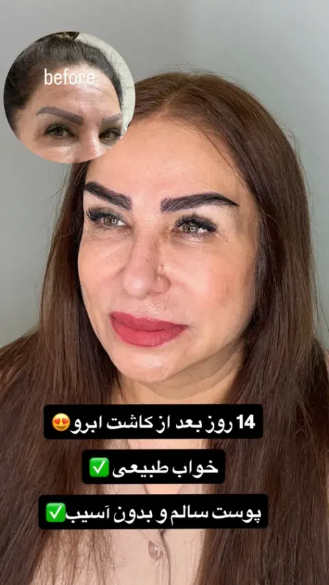 کاشت ابرو سلطانی متد پنج زاویه
