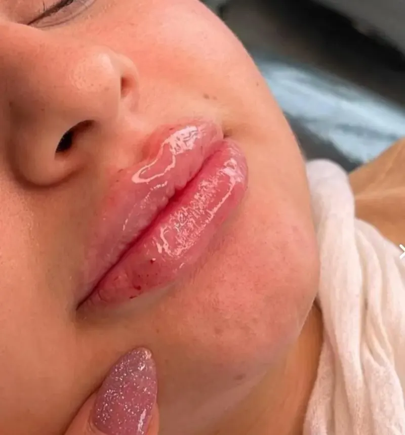 خدمات ژل بوتاکس مریم مرادی در تبریز