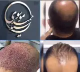 کلینیک تخصصی کاشت مو و ابرو کیارش در رشت