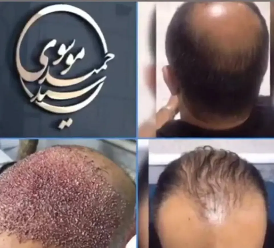 کلینیک تخصصی کاشت مو و ابرو کیارش در رشت