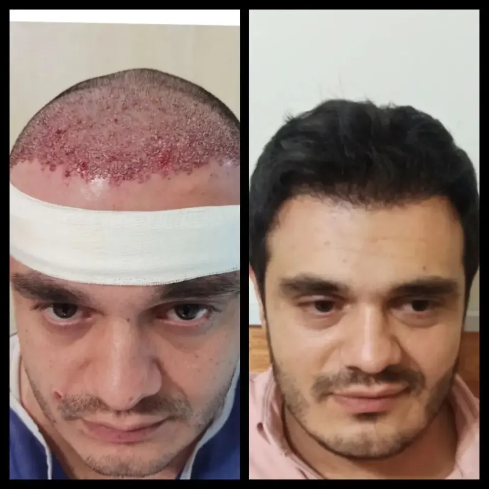کلینیک کاشت مو سهند در تبریز