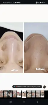 فیشال و پاکسازی پوست صورت با برند بلتر