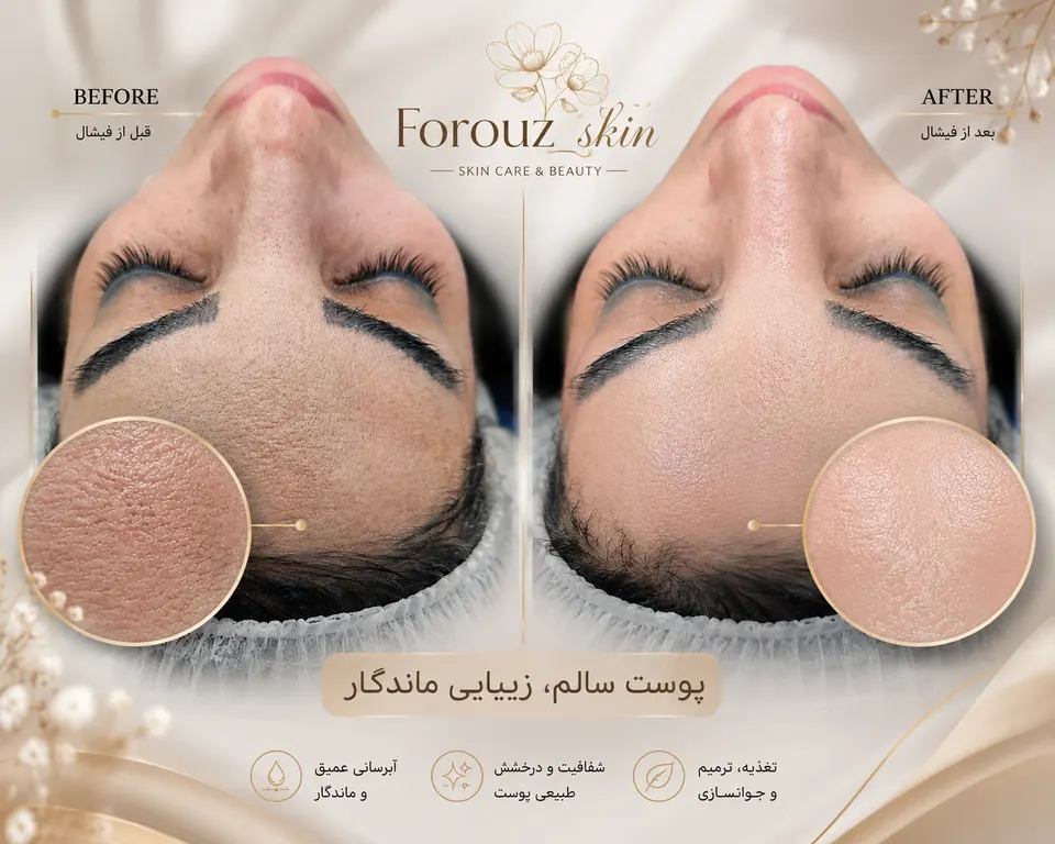 پاکسازی و فیشیال درمانی فروزان