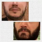 کاشت مو و ابرو کرج